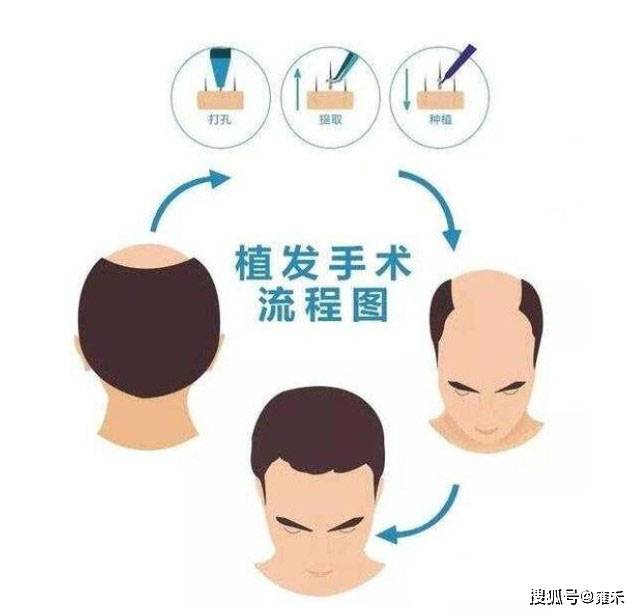 植发新选择，种头发哪里好？——全面解析与指南