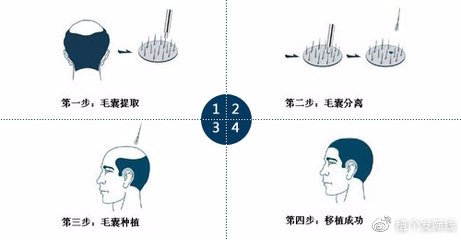 毛发移植专家，重塑自信的发现之旅