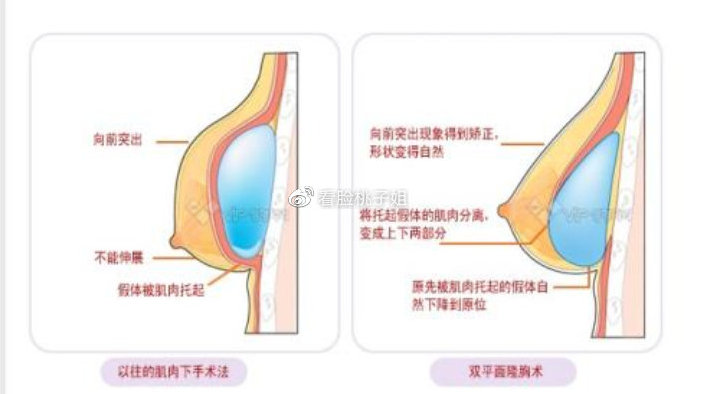 哪里隆胸手术做得好？——全面解析与选择指南