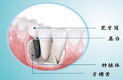 北京地区种植牙价格解析，影响价格的因素与选择建议