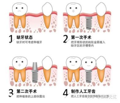 种植牙，价格与价值的深度解析