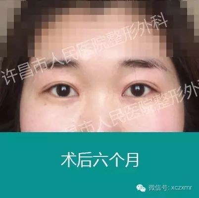 探索专业双眼皮整形的奥秘，从美学到科学的完美蜕变