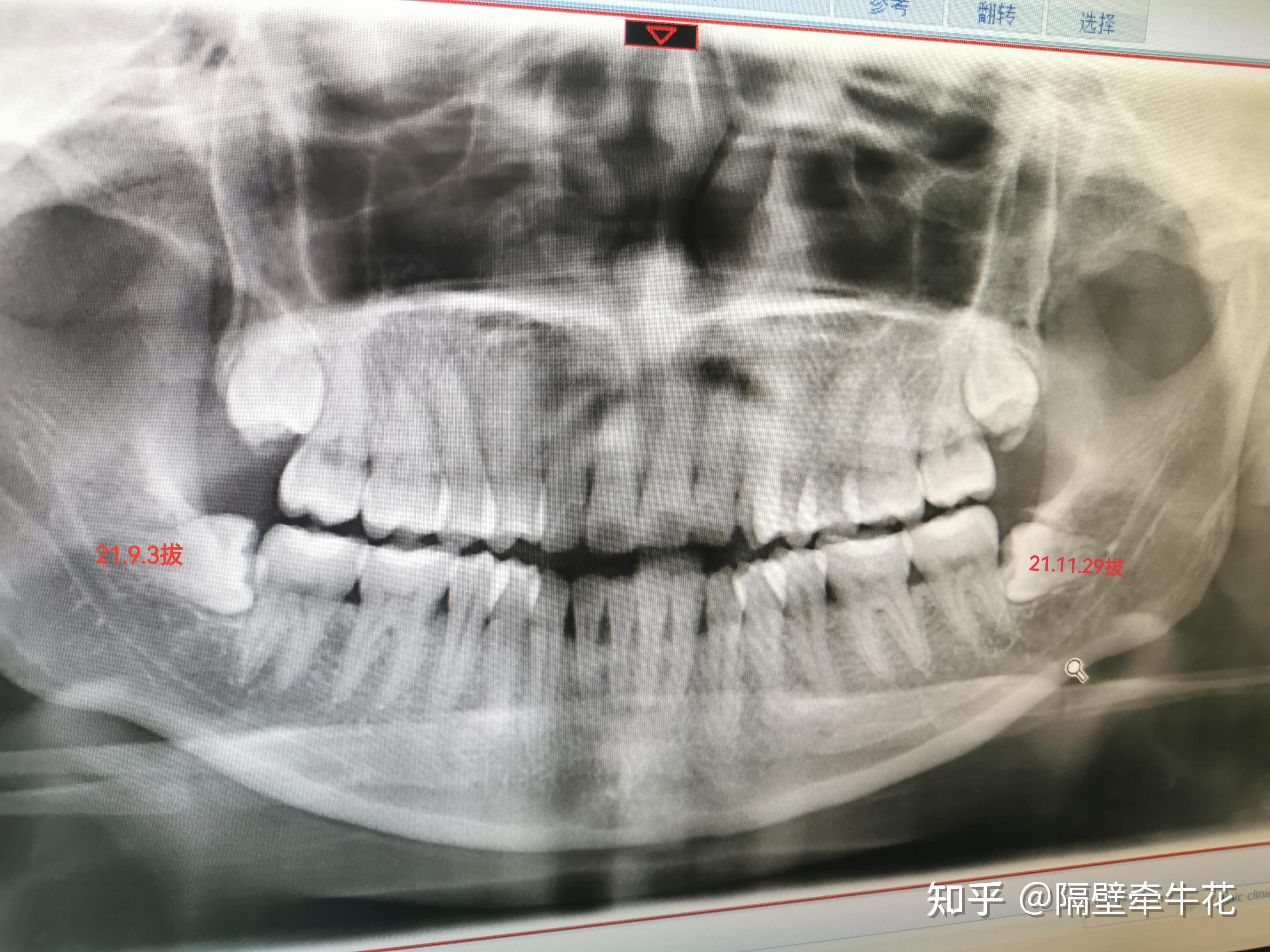 拔了智齿，一次决定，终身无悔的选择