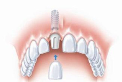 何时能用上降价后的种植牙，政策、技术、市场三重奏的未来展望