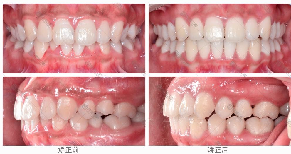 牙齿矫正的价格，全面解析与影响因素