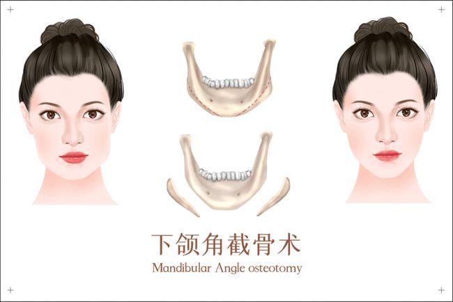 了解做下颌角的全面指南，价格、效果与注意事项