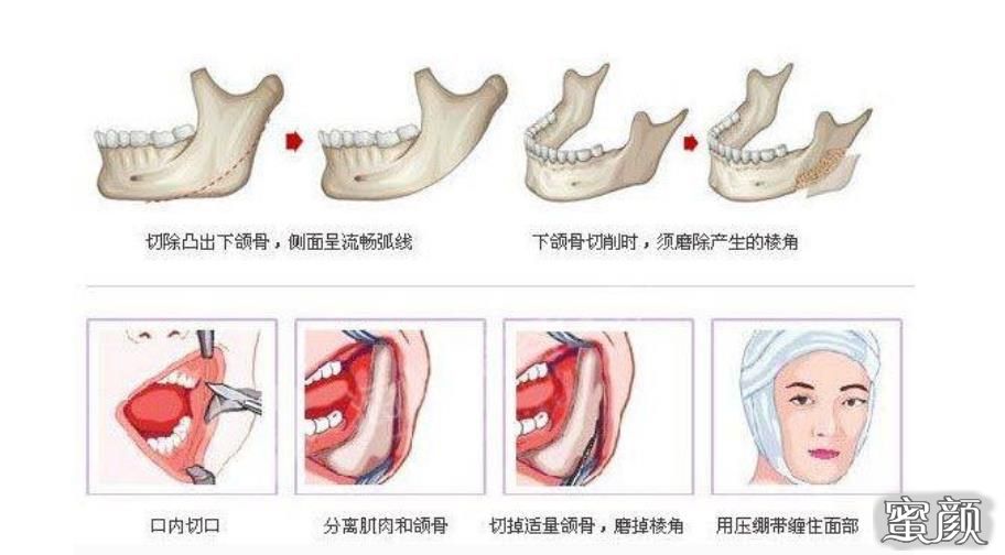 磨骨瘦脸手术，价格、风险与选择