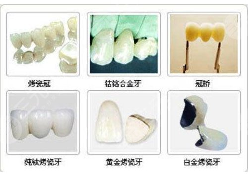 烤瓷牙价格表，全面解析与选择指南