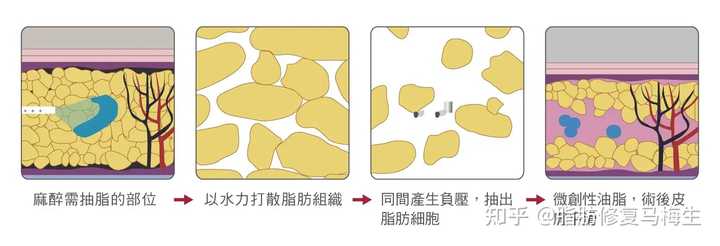 光纤溶脂，美丽背后的隐忧