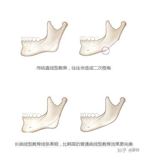 削骨手术过程全解析，从准备到恢复的每一步