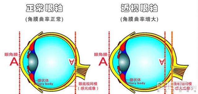 近视矫正价格，影响因素与选择指南