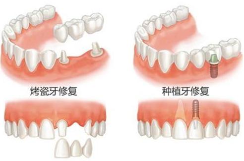 医院种牙一颗多少钱，全面解析与影响因素