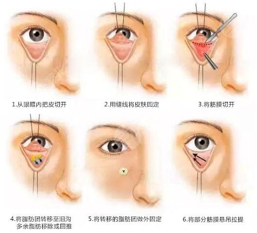 手术去除眼袋，价格与价值的考量