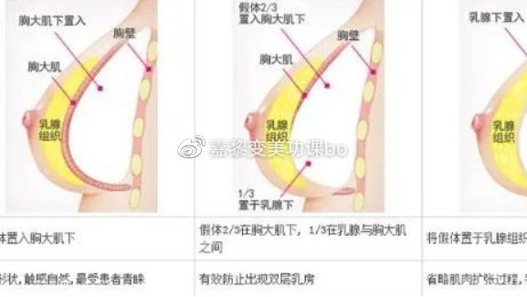 探秘无痕隆胸，费用、效果与安全考量