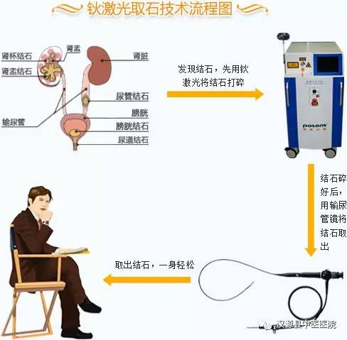 激光碎石技术，现代医疗的精准之选