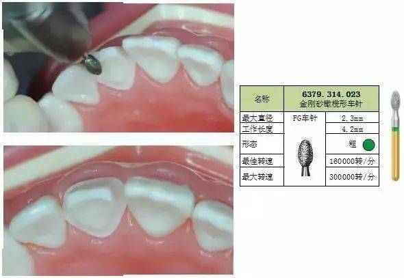 种植牙齿，价格、价值与选择的深度解析