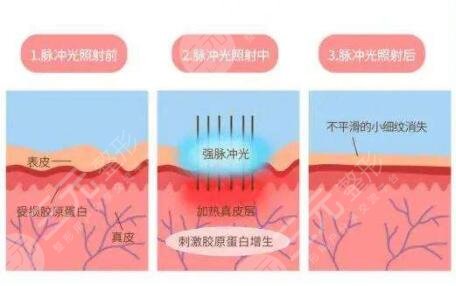 彩光嫩肤手术，价格与效果的平衡艺术