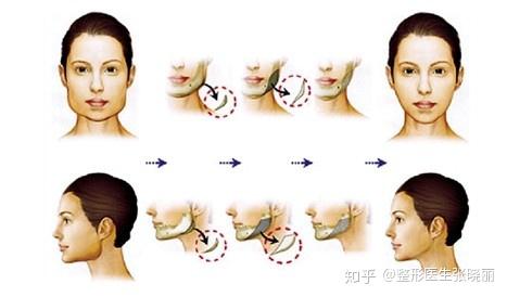 面部轮廓重塑，面部吸脂与去颊脂垫的全面解析
