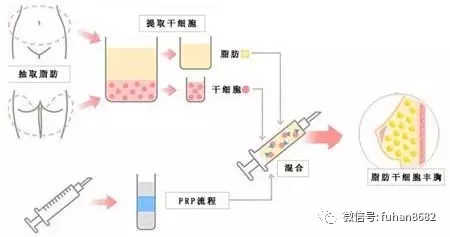 干细胞丰胸，价格与效果的深度解析