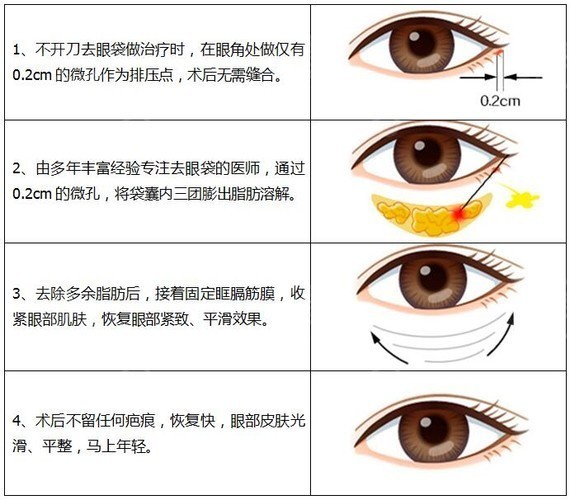 内切祛眼袋，重焕青春明眸的秘密武器