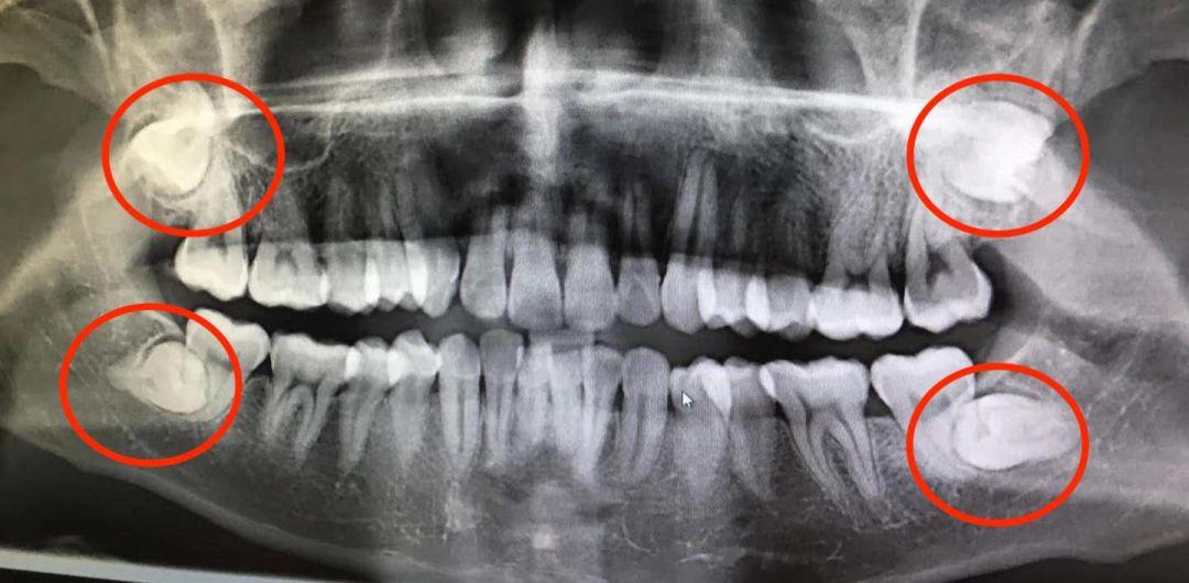 一次拔两颗智齿，我的后悔之旅