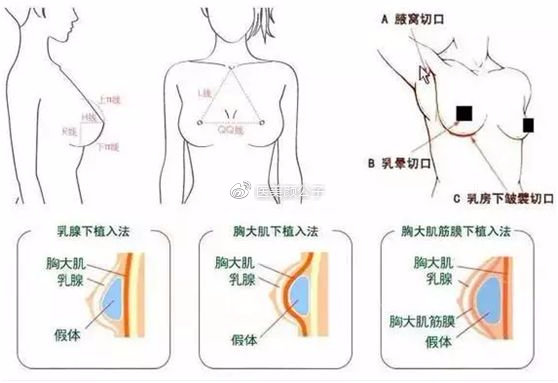 假体丰胸手术，价格、选择与考量