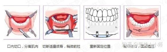 垫下巴手术，价格与价值的考量