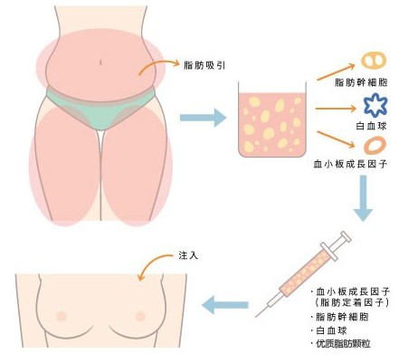 环形吸脂价格，全面解析与影响因素