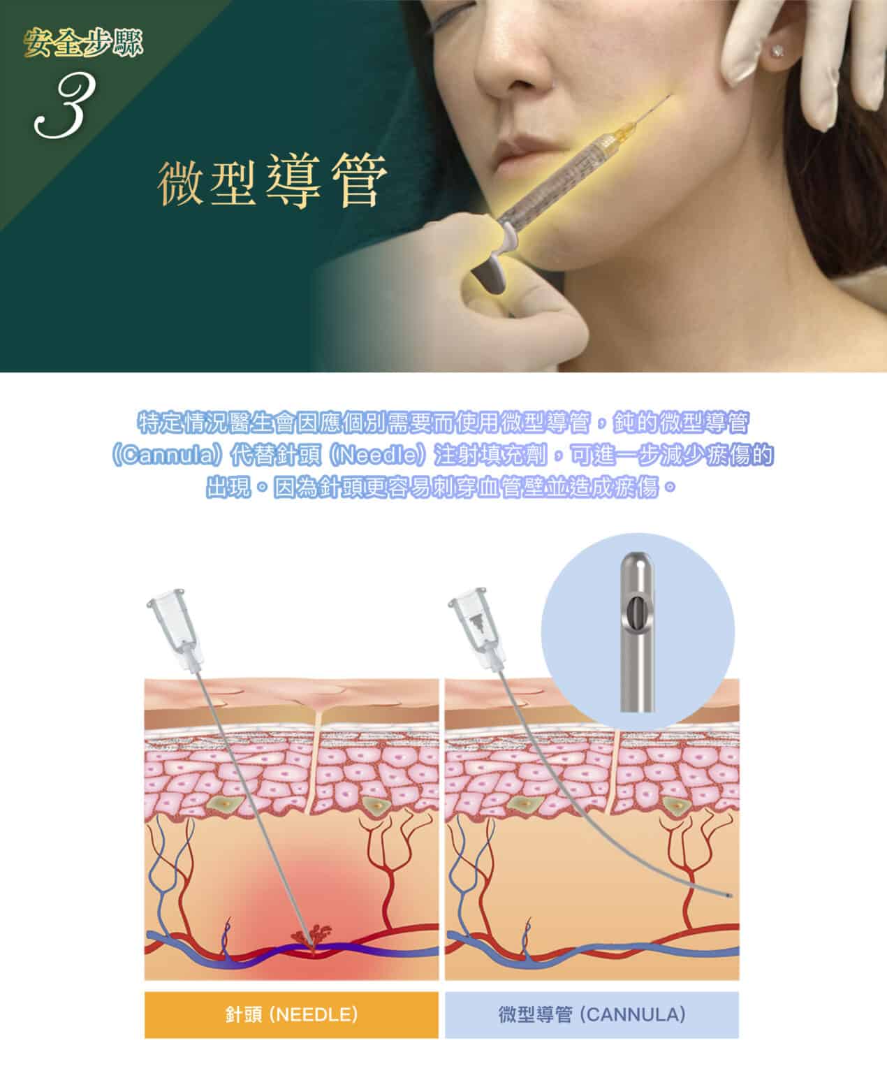 探索Restylane，重塑肌肤活力的非手术美容新选择