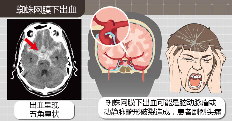 虹网，构建未来数字世界的桥梁虹网膜下腔出血是什么原因